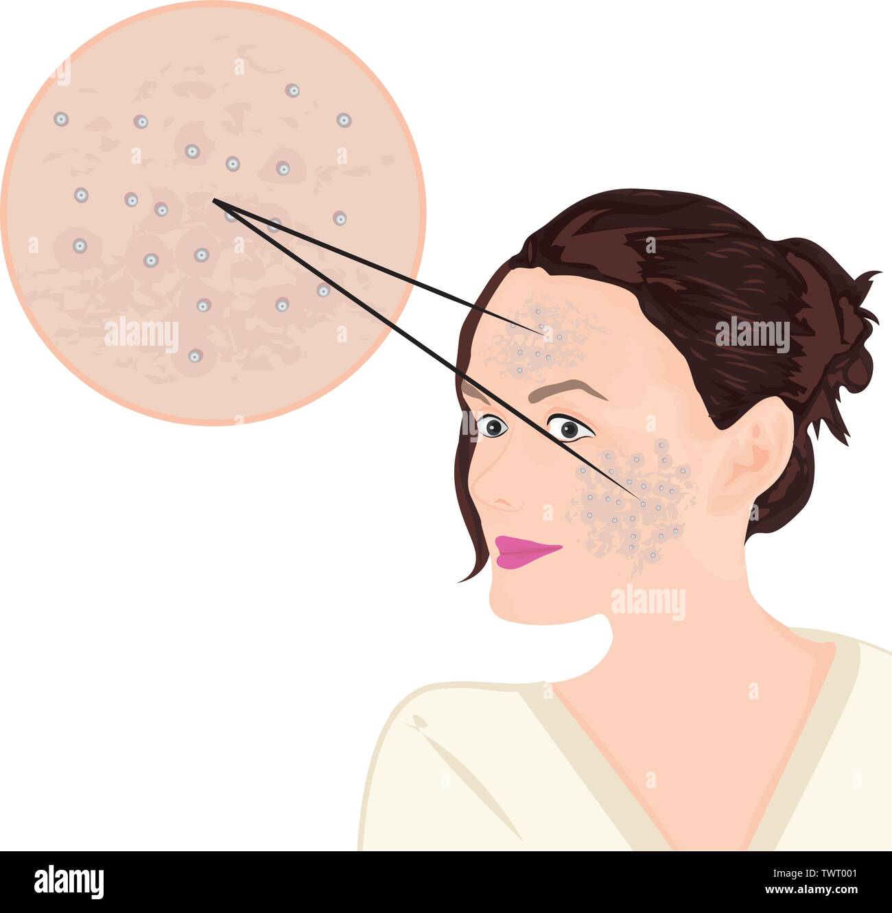 Acne on a face vector illustration showing skin problem Stock Vector ...