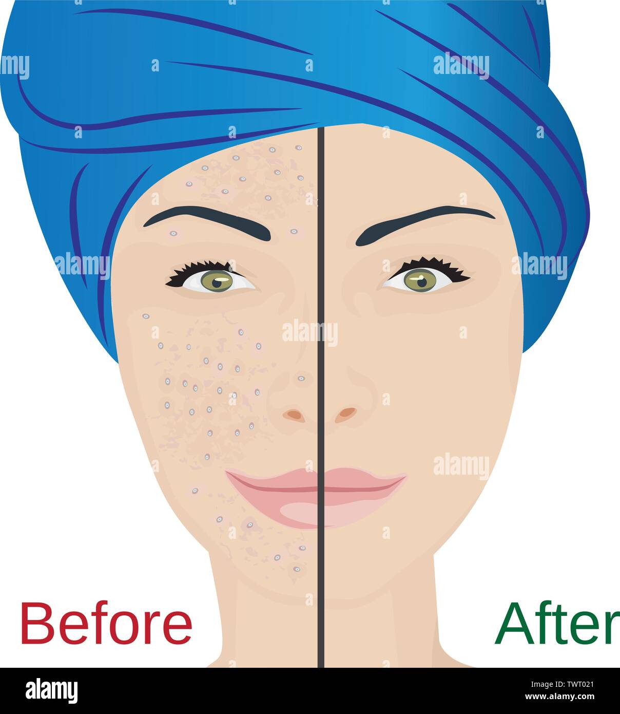 Acne pustules on a woman face and a treatment result before and after. vector illustration. Cosmetology concept, dermatology skin disease Stock Vector