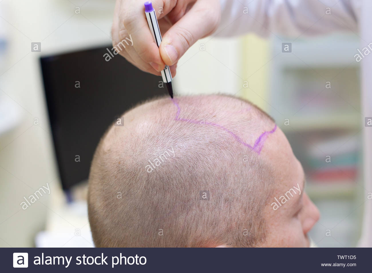 Baldness Treatment Patient Suffering From Hair Loss In