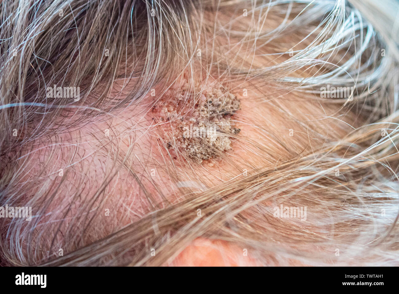 Seborrheic keratoses benign skin tumour on a male scalp with a bumpy appearance. Head lesion. Large wart like growth in hairline. Medical condition Stock Photo