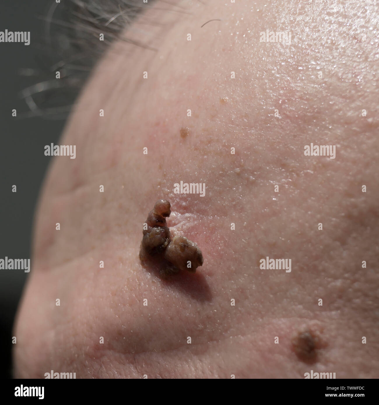 close up of suspicious mole on skin, outdoor Stock Photo