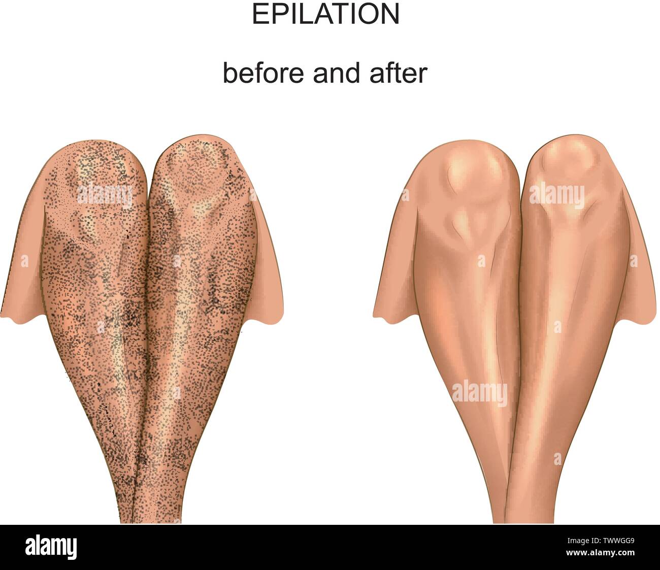 vector illustration of legs before and after hair removal Stock Vector  Image & Art - Alamy