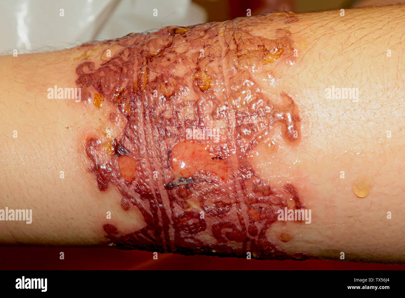 Réaction allergique importante après un tatouage au henné Stock Photo -  Alamy