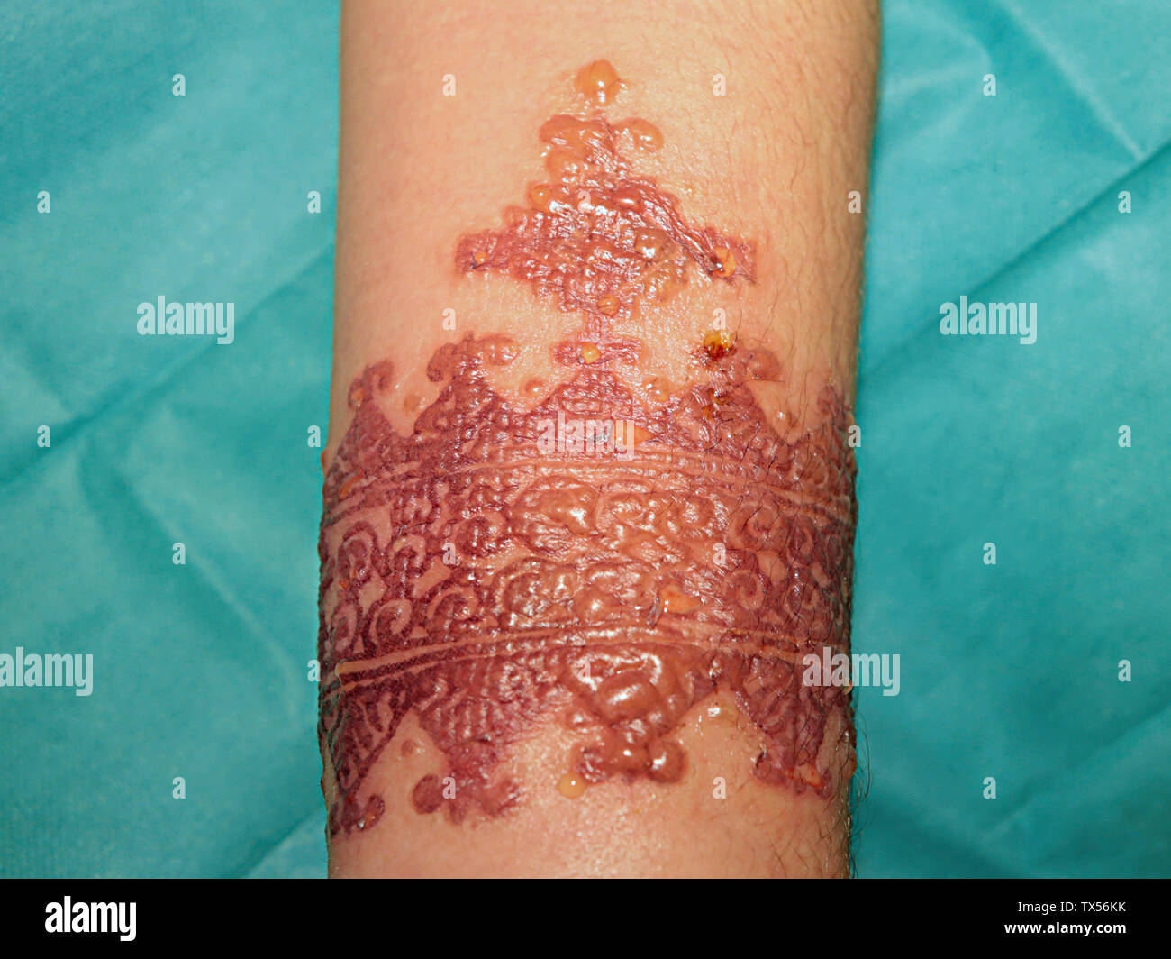 Reaction Allergique Importante Apres Un Tatouage Au Henne Stock Photo Alamy