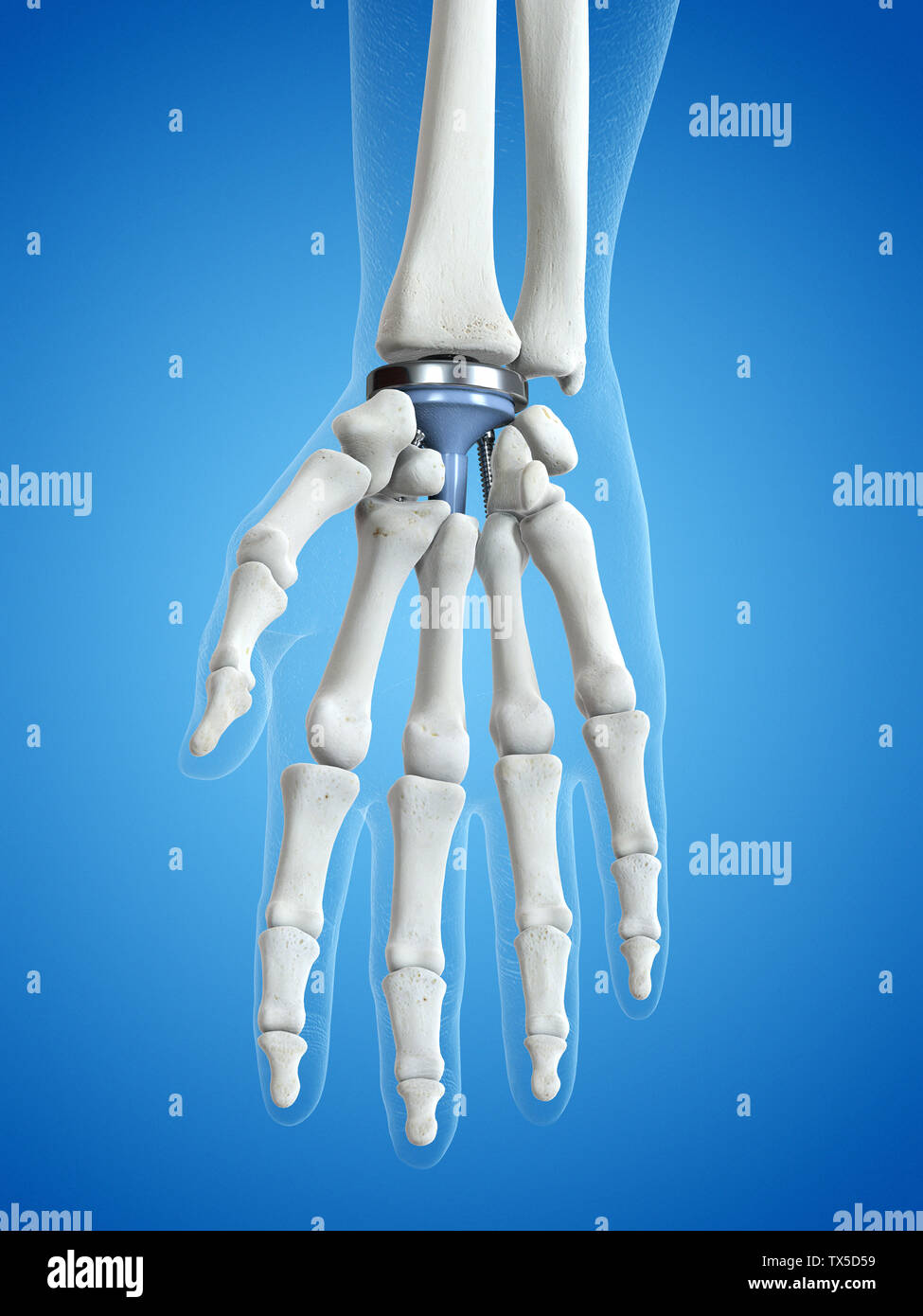 3d rendered medically accurate illustration of a wrist replacement