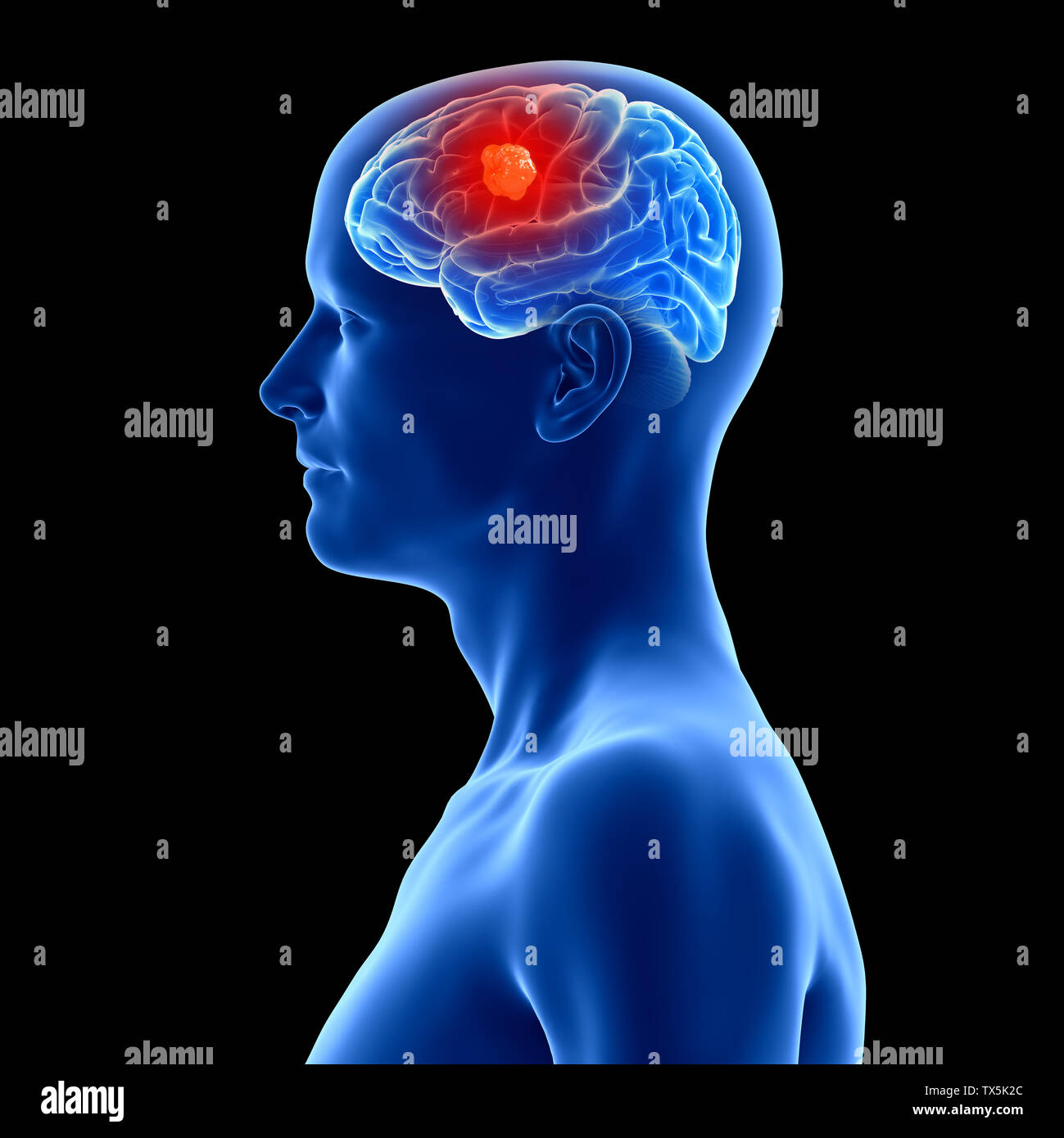 3d rendered, medically accurate illustration of a brain tumor Stock ...