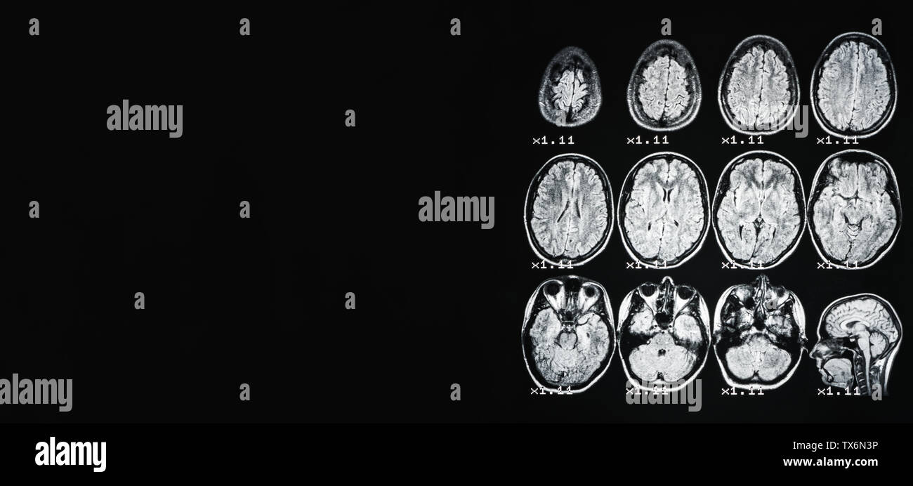 Banner Mri Of The Brain Of A Healthy Person On A Black Background