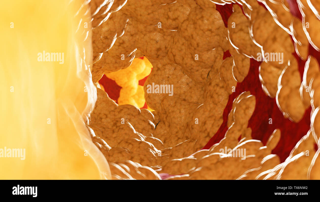 3d rendered medically accurate illustration of fat inside of an artery Stock Photo