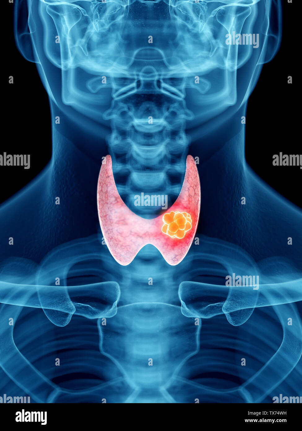 3d rendered medically accurate illustration of a mans thyroid tumor ...