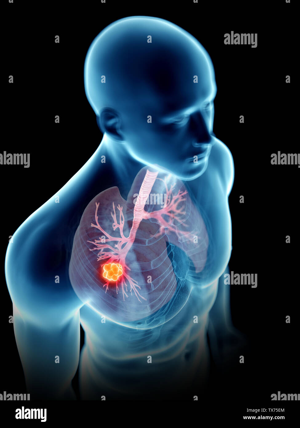 3d rendered medically accurate illustration of a mans lung tumor Stock ...