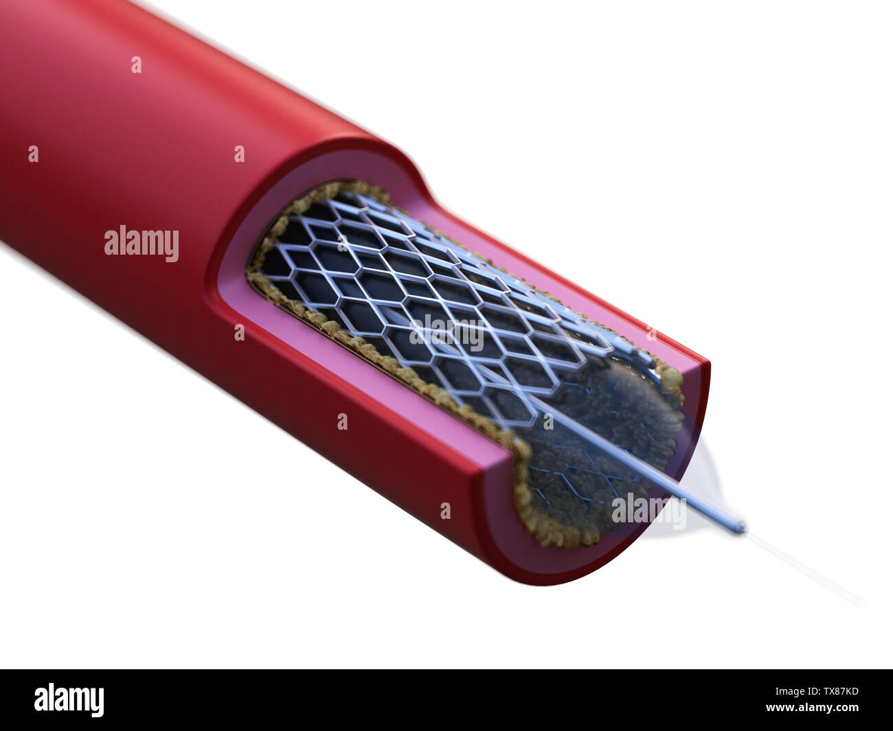 Atherosclerosis Artwork Hi Res Stock Photography And Images Alamy