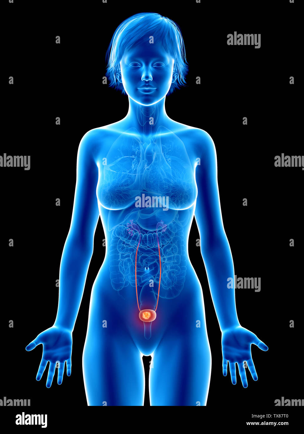 medically accurate 3d rendering of a female´s bladder cancer Stock Photo