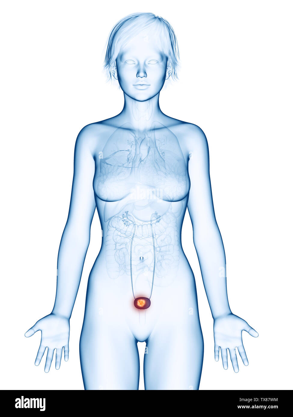 medically accurate 3d rendering of a female´s bladder cancer Stock Photo
