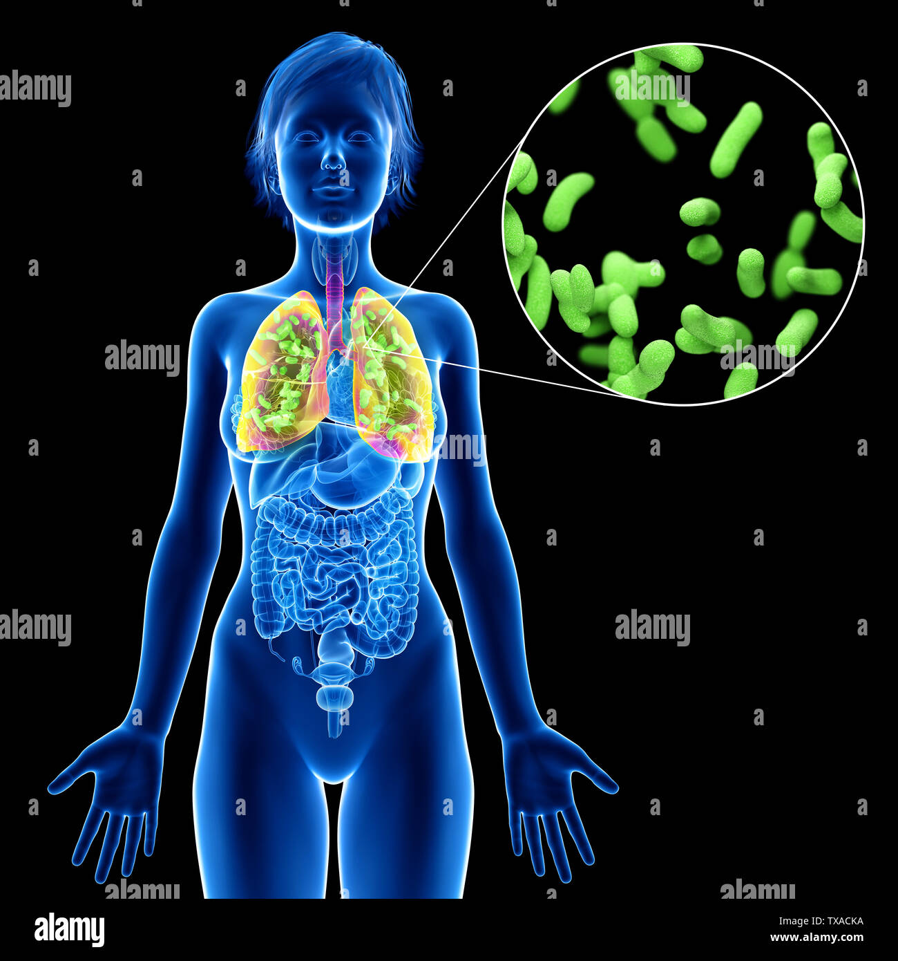 Lung infection hi-res stock photography and images - Alamy