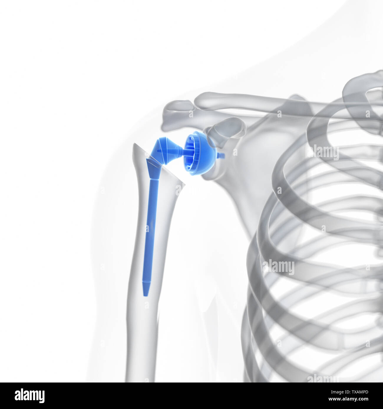 3d rendered medically accurate illustration of a shoulder replacement Stock Photo
