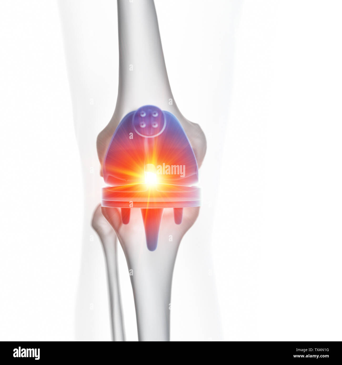 3d rendered medically accurate illustration of a knee replacement Stock Photo