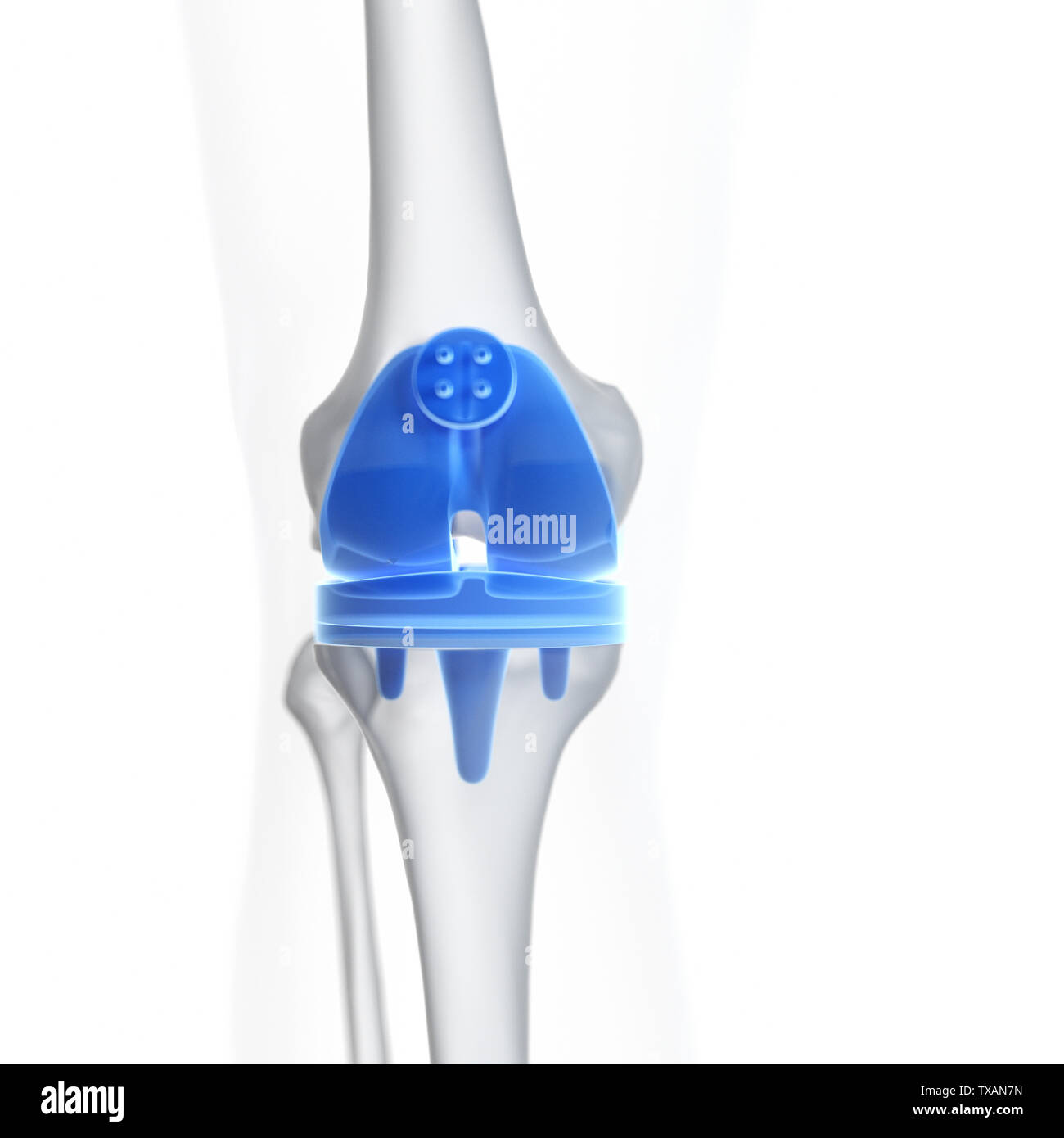 3d rendered medically accurate illustration of a knee replacement Stock Photo