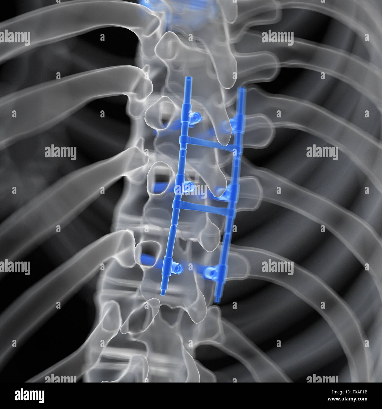 Spinal fusion hires stock photography and images Alamy