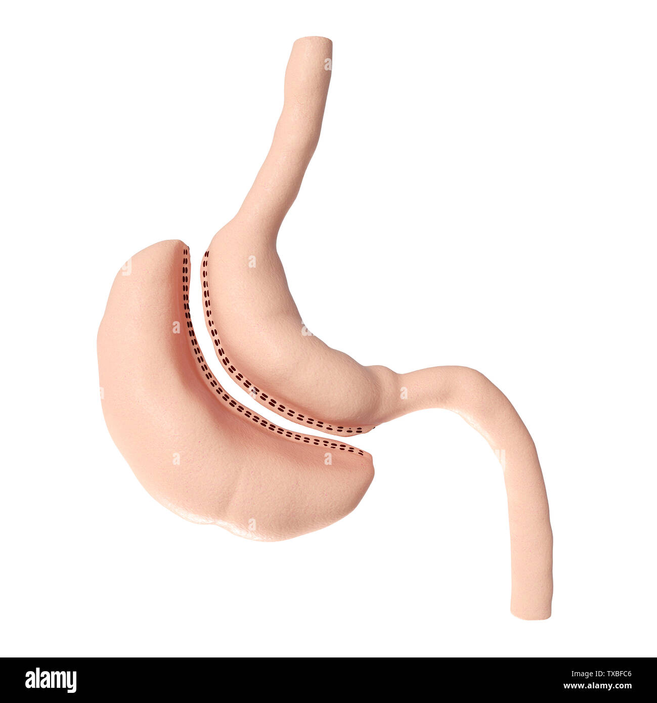 3d rendered medically accurate illustration of a vertical sleeve gastrectomy Stock Photo Alamy
