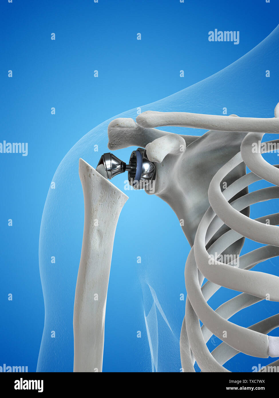 Shoulder Joint Replacement High Resolution Stock Photography and Images ...