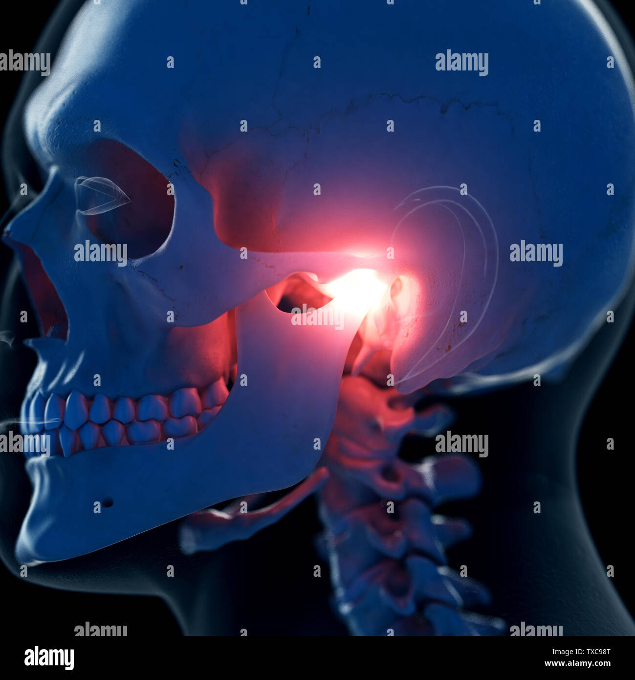 3d rendered medically accurate illustration of a a painful temporomandibular joint Stock Photo