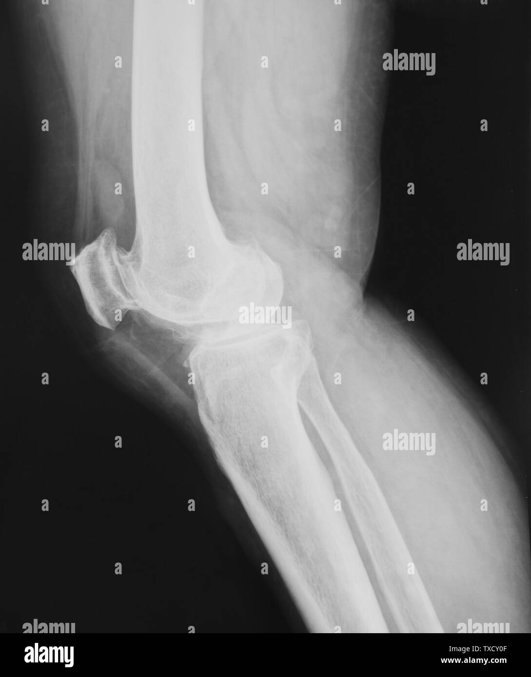 Collection of x-ray normal knee Stock Photo