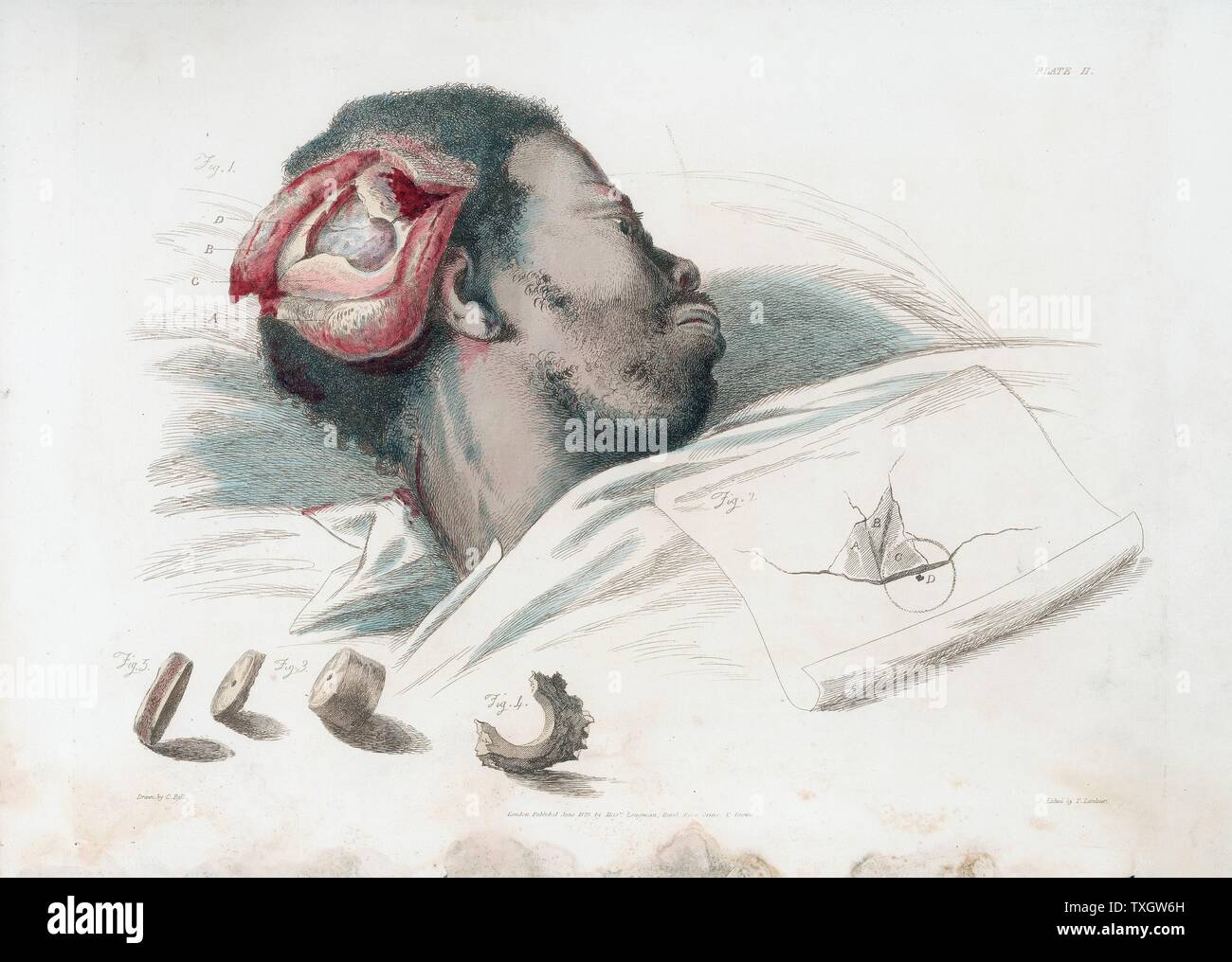 View of wound in skull after trephination and removal of shattered bone, shown at  bottom left From Charles Bell 'The Great Operations of Surgery'  1821 Etching by Thomas Landseer after Bell London Stock Photo