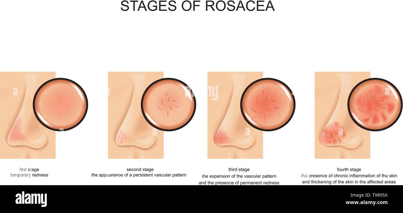 vector illustration of all four stages of rosacea Stock Vector