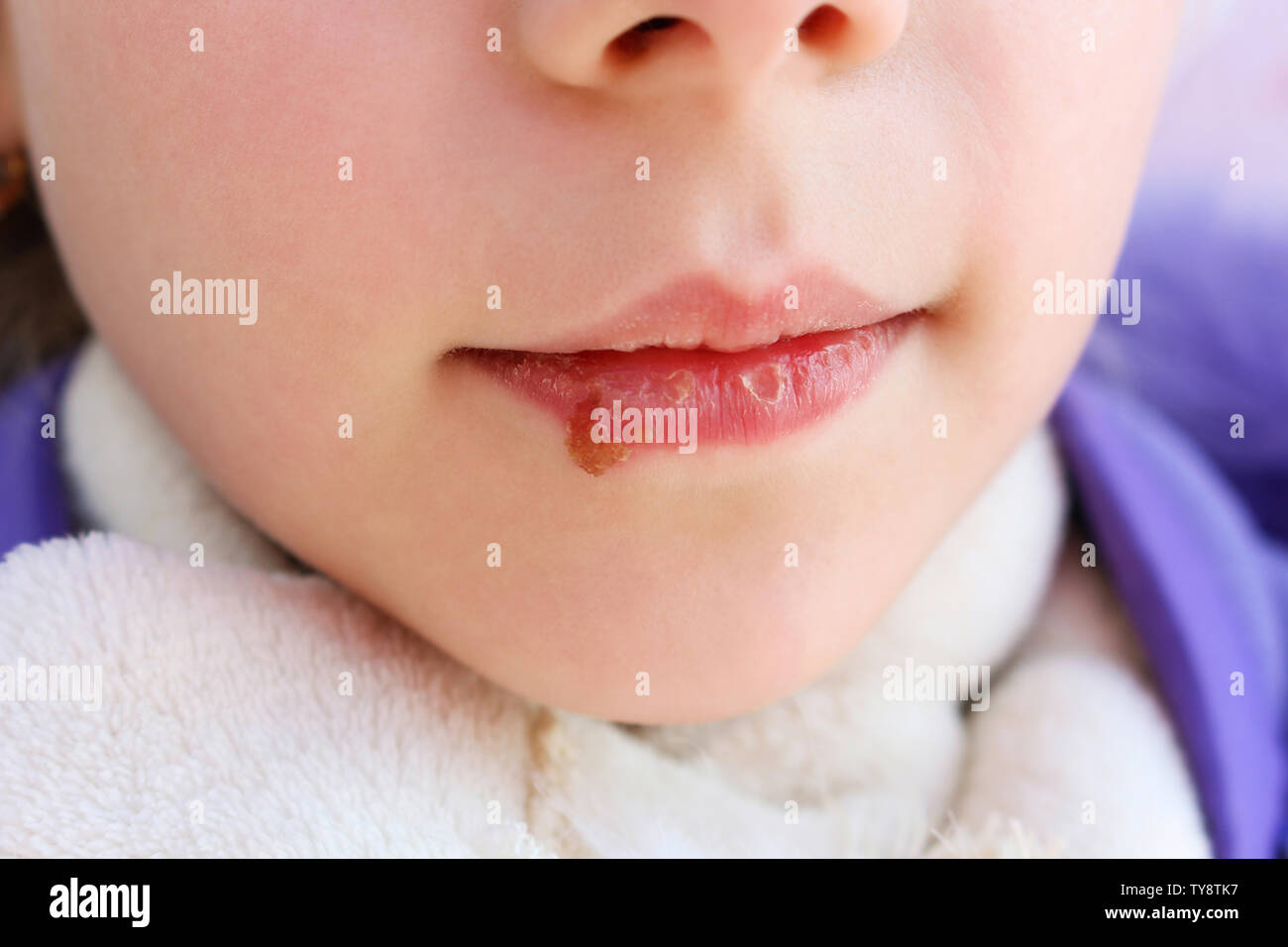 Herpes on lips of child. Treatment ointment. Stock Photo