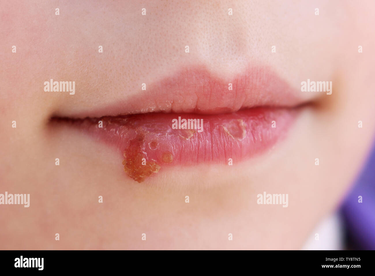 Herpes on lips of child. Treatment ointment. Stock Photo