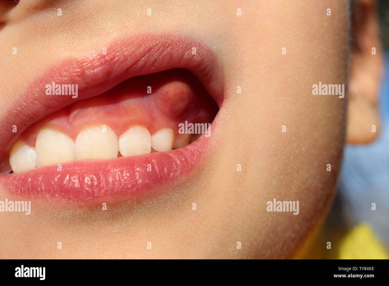 Fistula gums