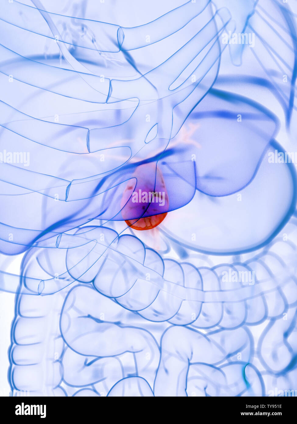 3d rendered medically accurate illustration of a diseased gallbladder Stock Photo