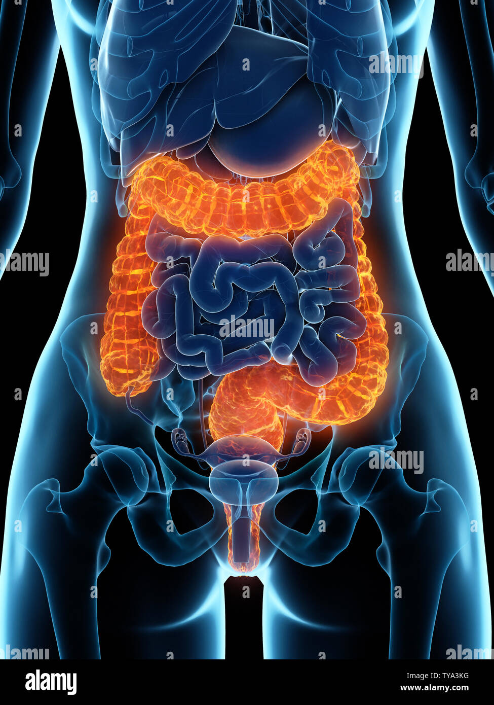 3d rendered medically accurate illustration of a diseased colon Stock ...