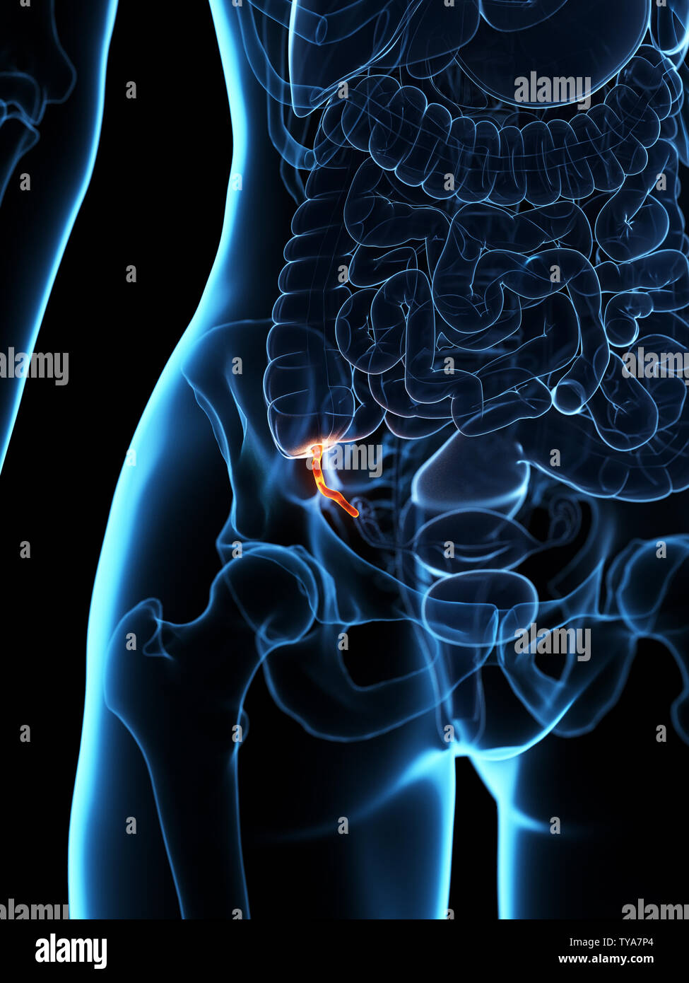 3d rendered medically accurate illustration of an inflamed appendix ...
