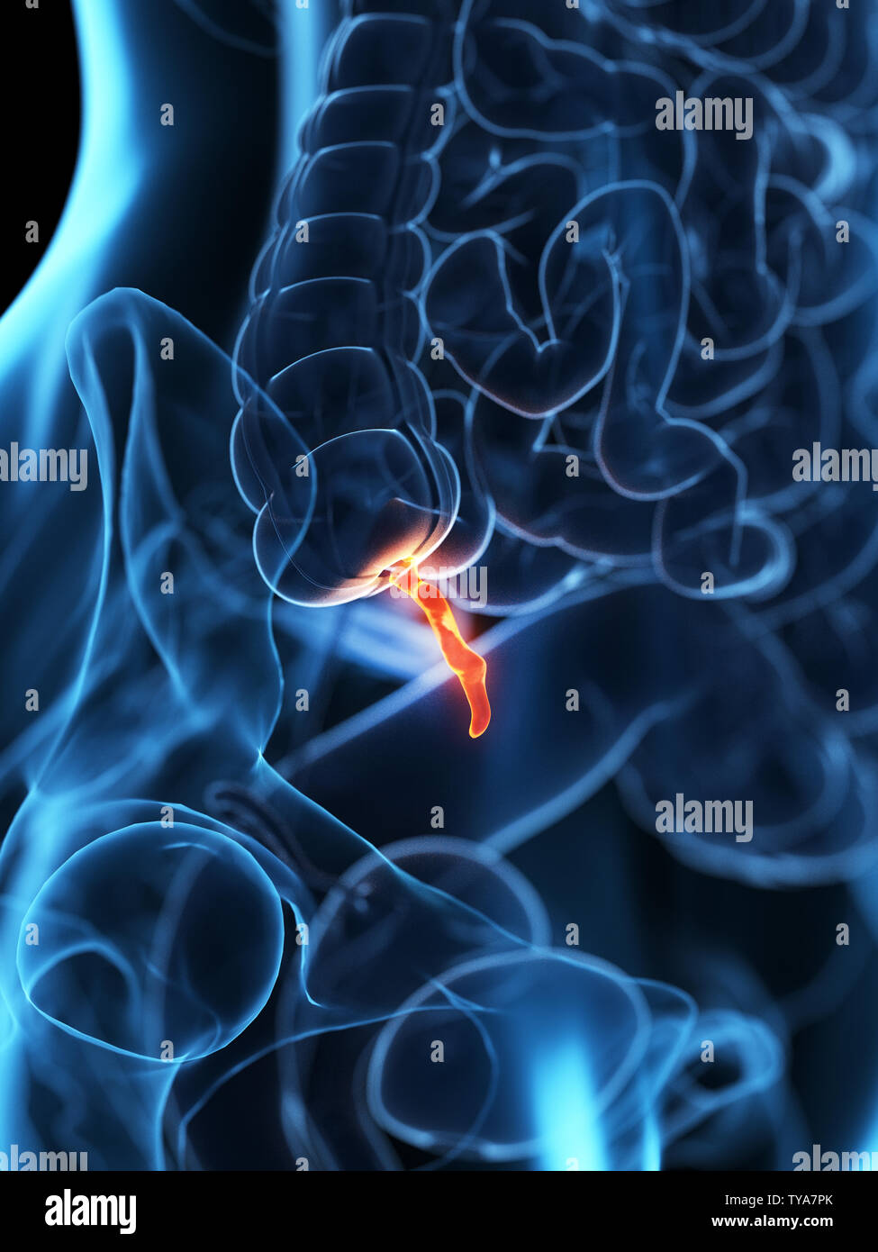 3d rendered medically accurate illustration of an inflamed appendix