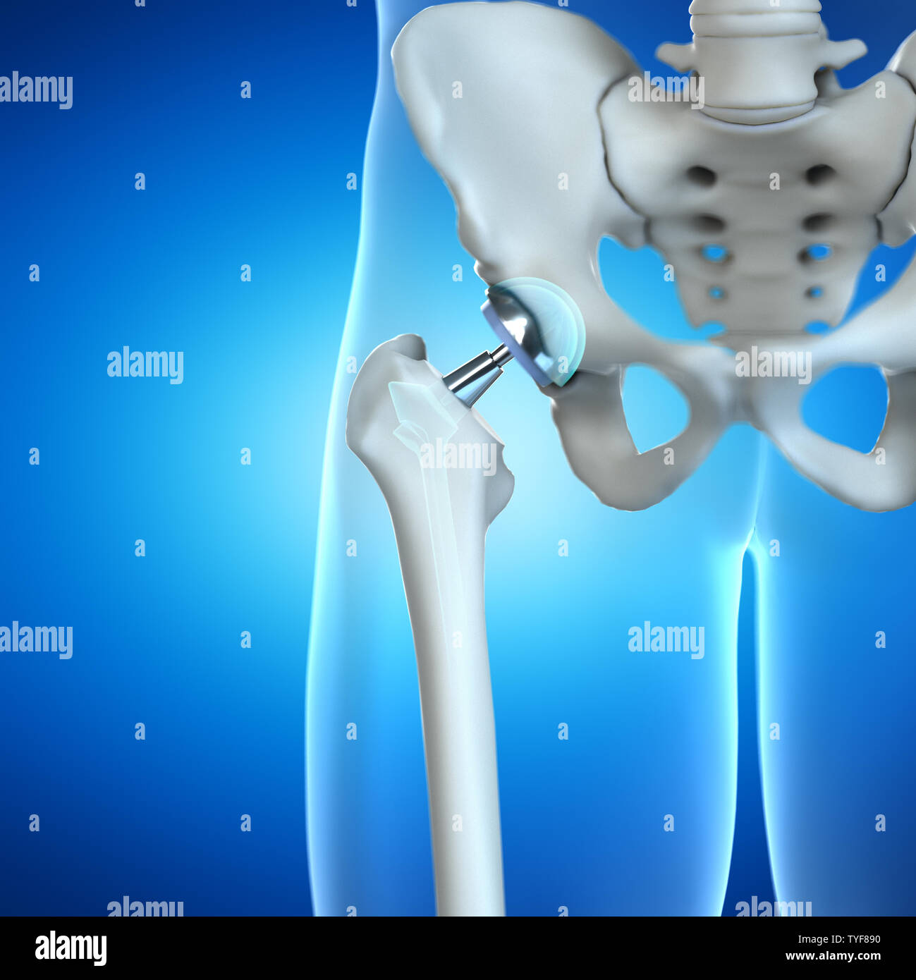 3d rendered illustration of a hip implant Stock Photo