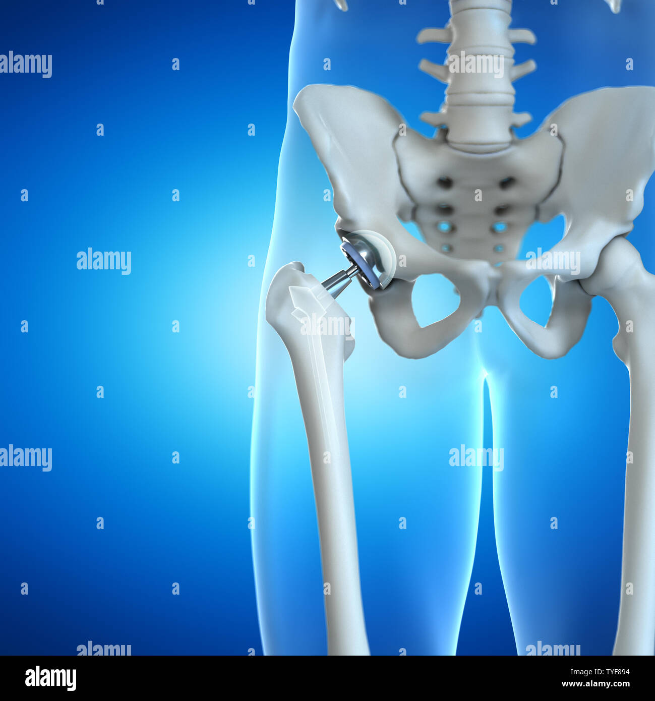 3d rendered illustration of a hip implant Stock Photo