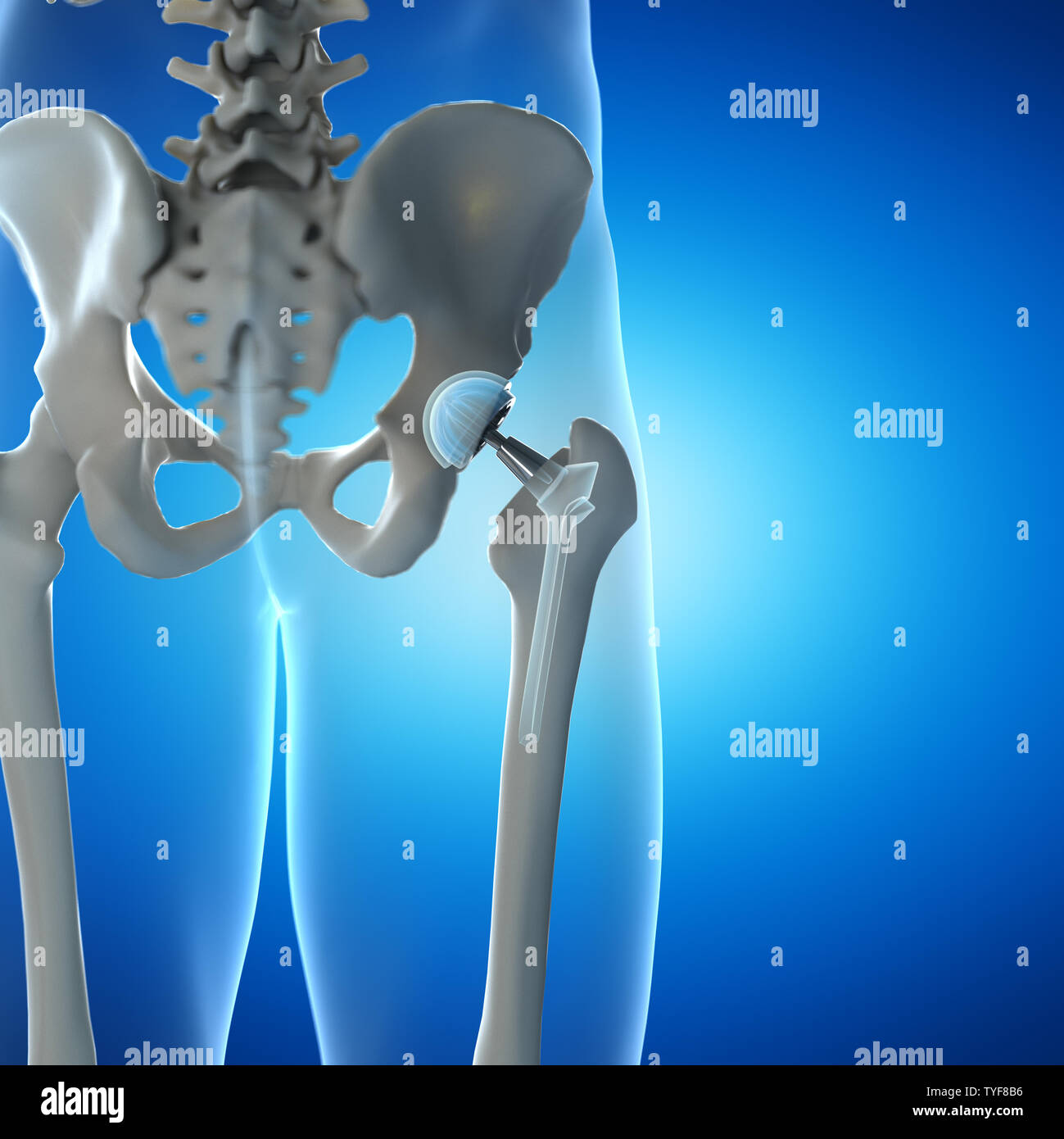 3d rendered illustration of a hip implant Stock Photo