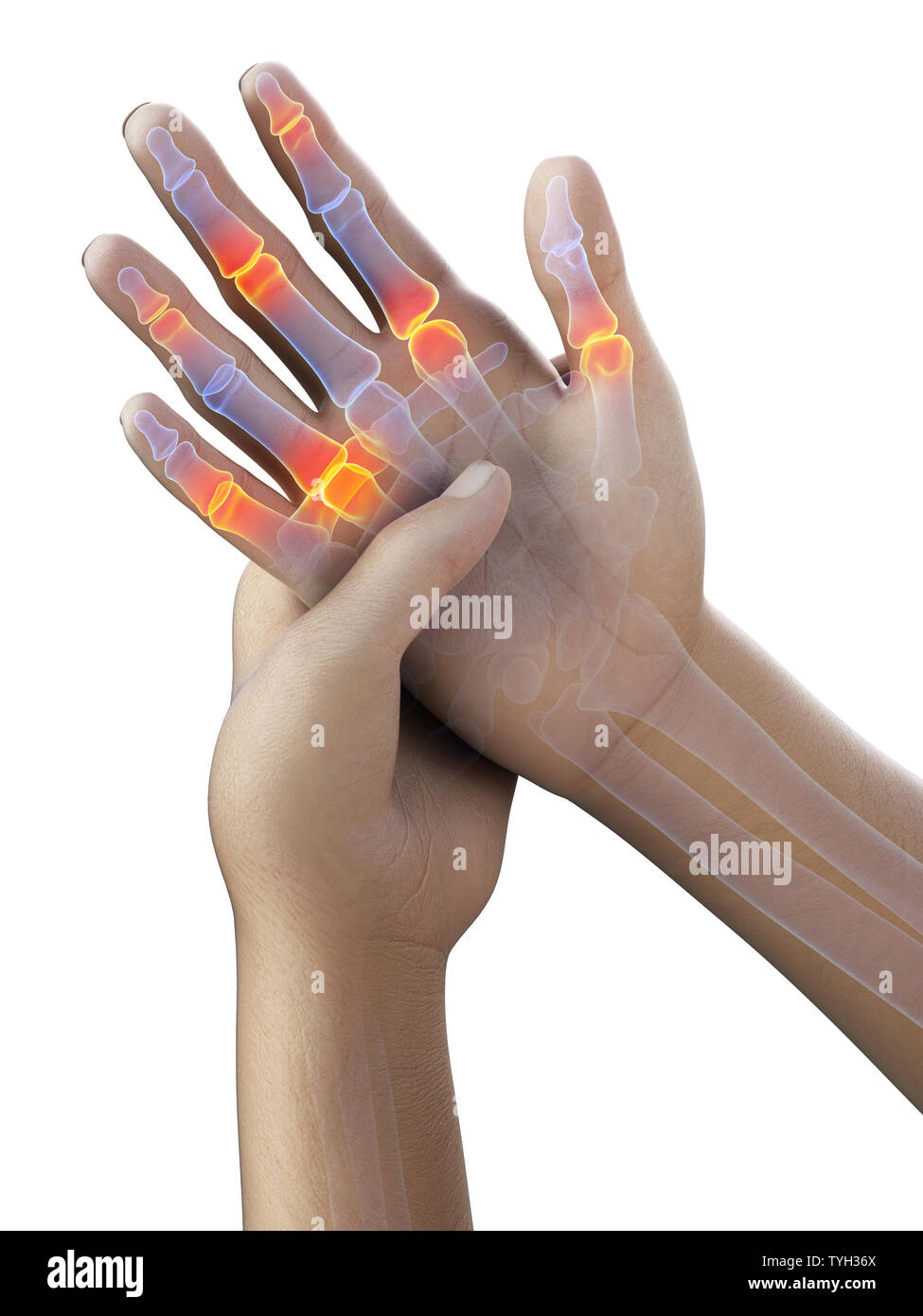 3d rendered medically accurate illustration of painful finger joints
