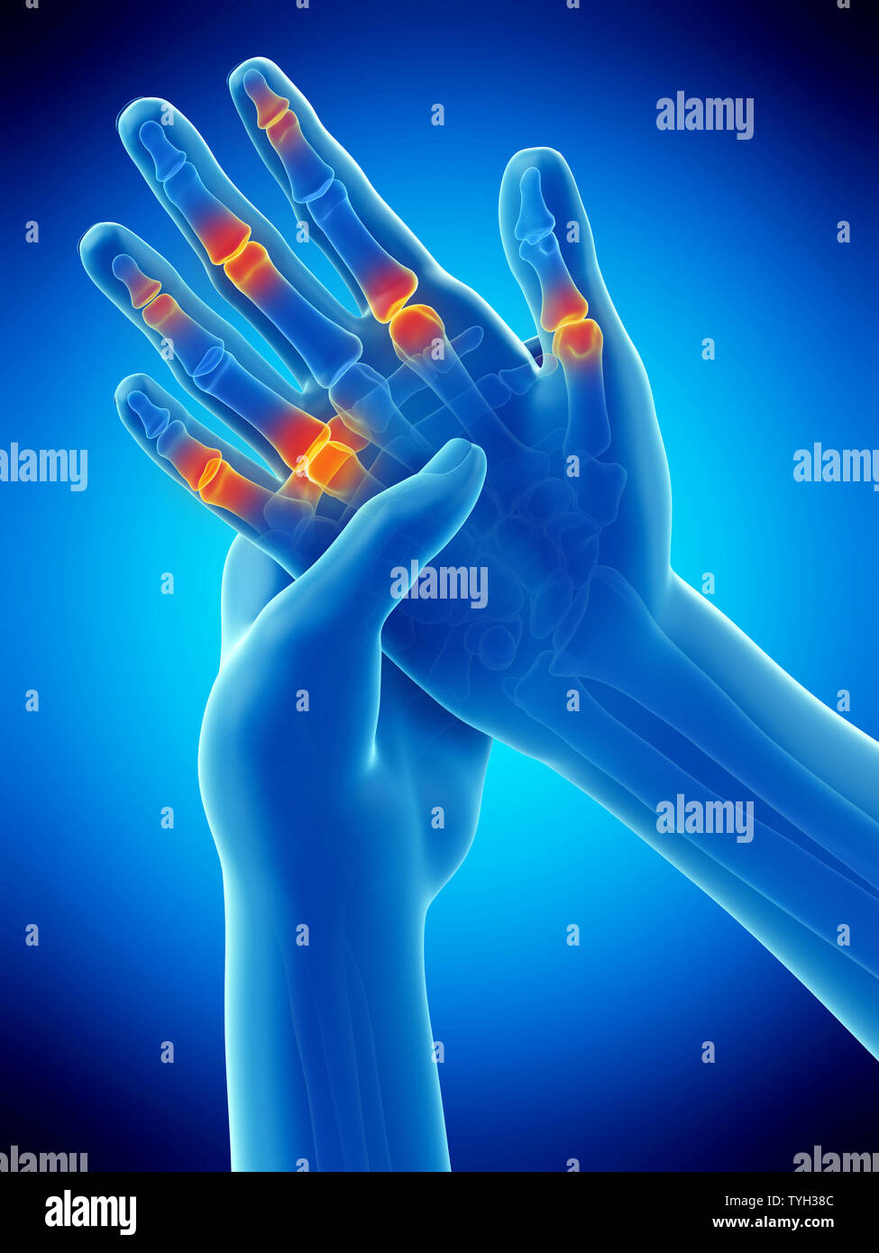 3d rendered medically accurate illustration of painful finger joints Stock Photo Alamy