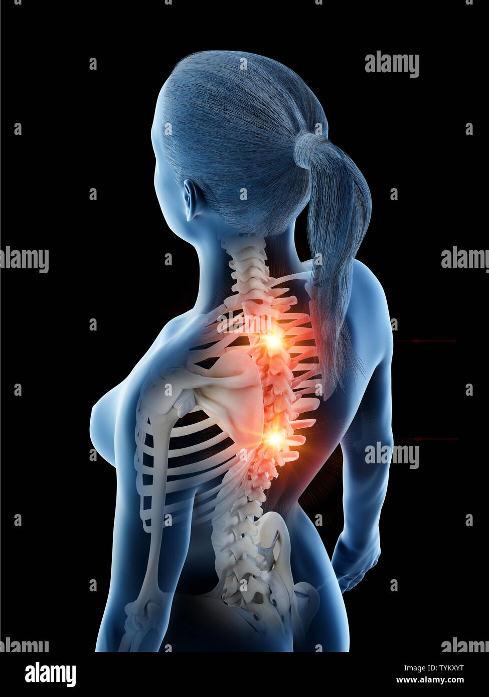 3d rendered illustration of a females painful back Stock Photo - Alamy