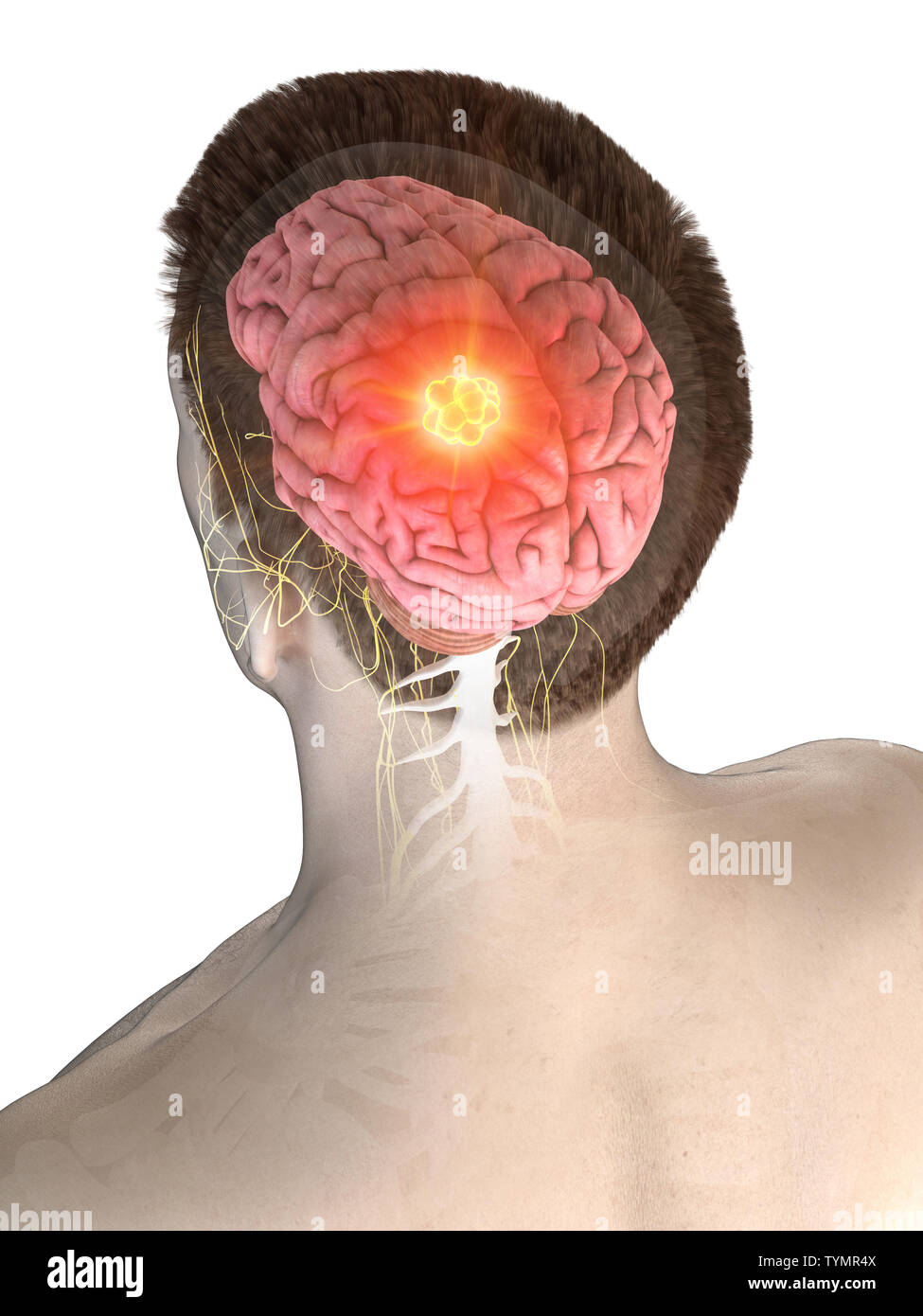 3d rendered medically accurate illustration of a mans brain tumor Stock ...