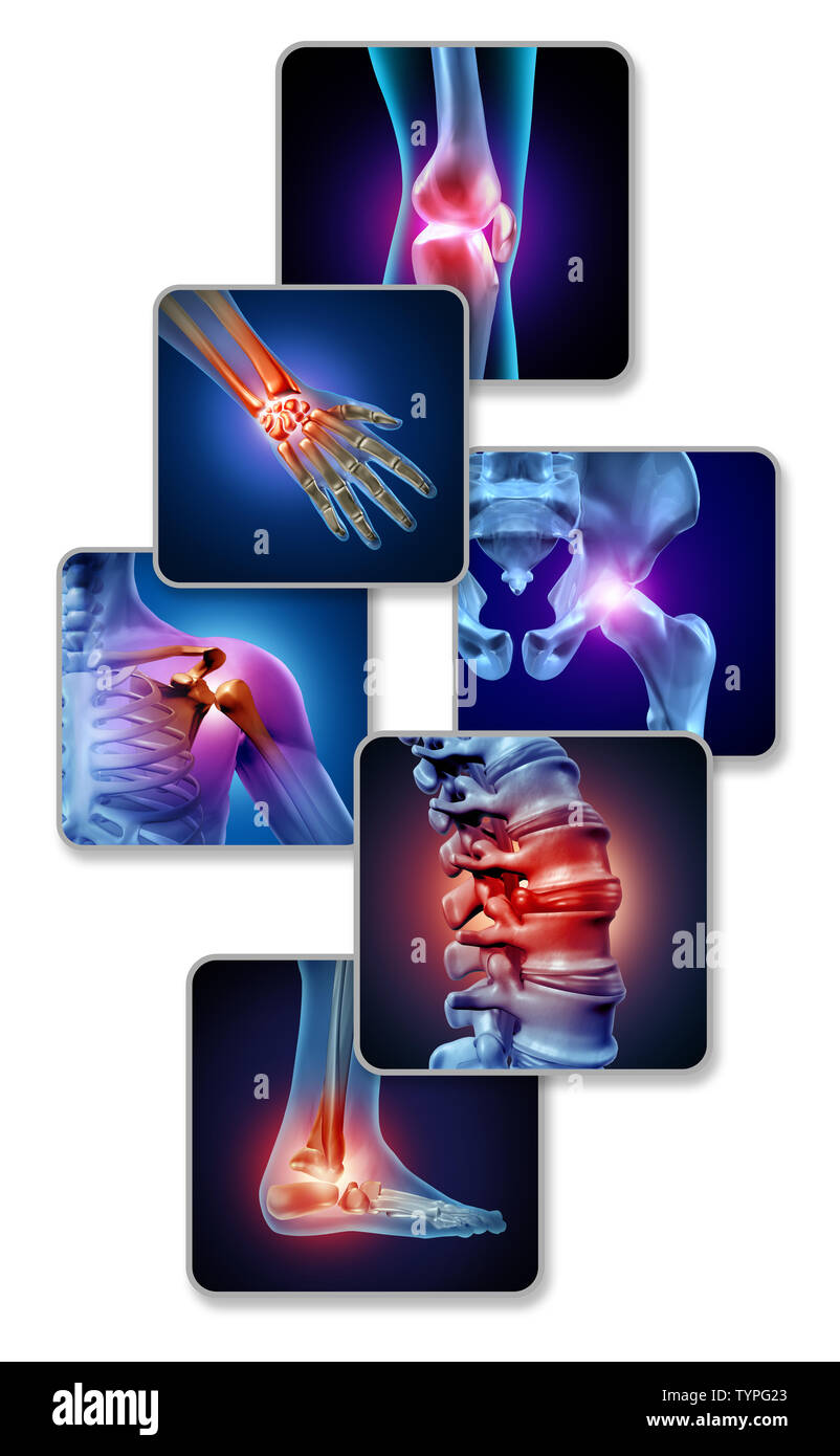 Human joint pain concept as skeleton and muscle anatomy of the body with a group of sore joints as a painful injury or arthritis illness. Stock Photo