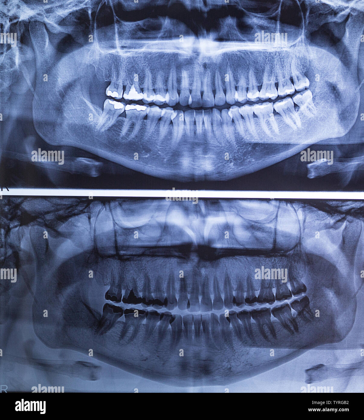 Dental XRay panoramic of upper and lower jaw Stock Photo Alamy