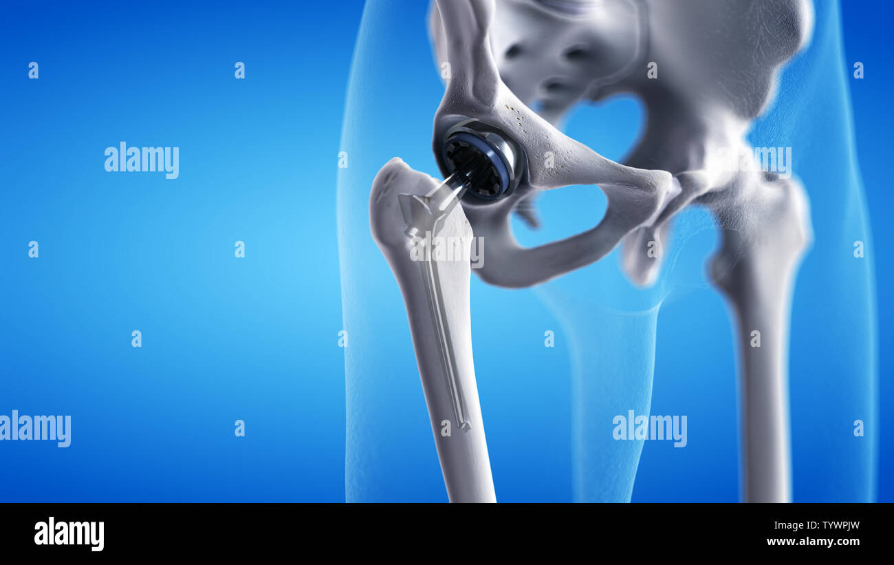 3d rendered medically accurate illustration of a hip replacement Stock Photo