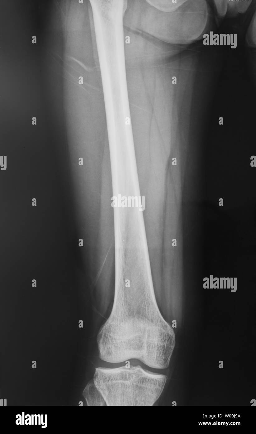 Collection of x-ray normal knee Stock Photo