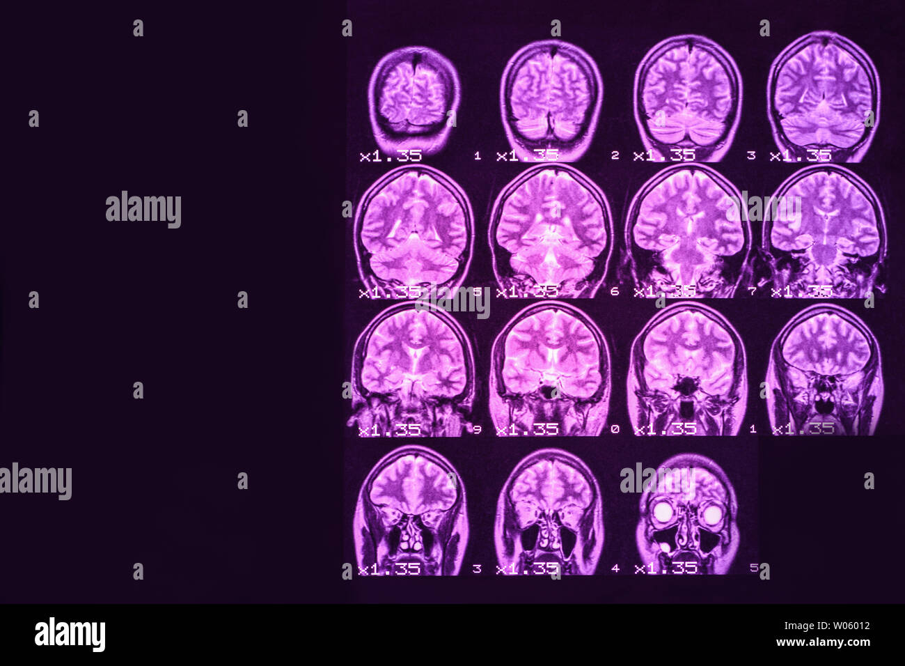 MRI of the brain on a black background with purple  backlight. Left  place for advertising inscription Stock Photo