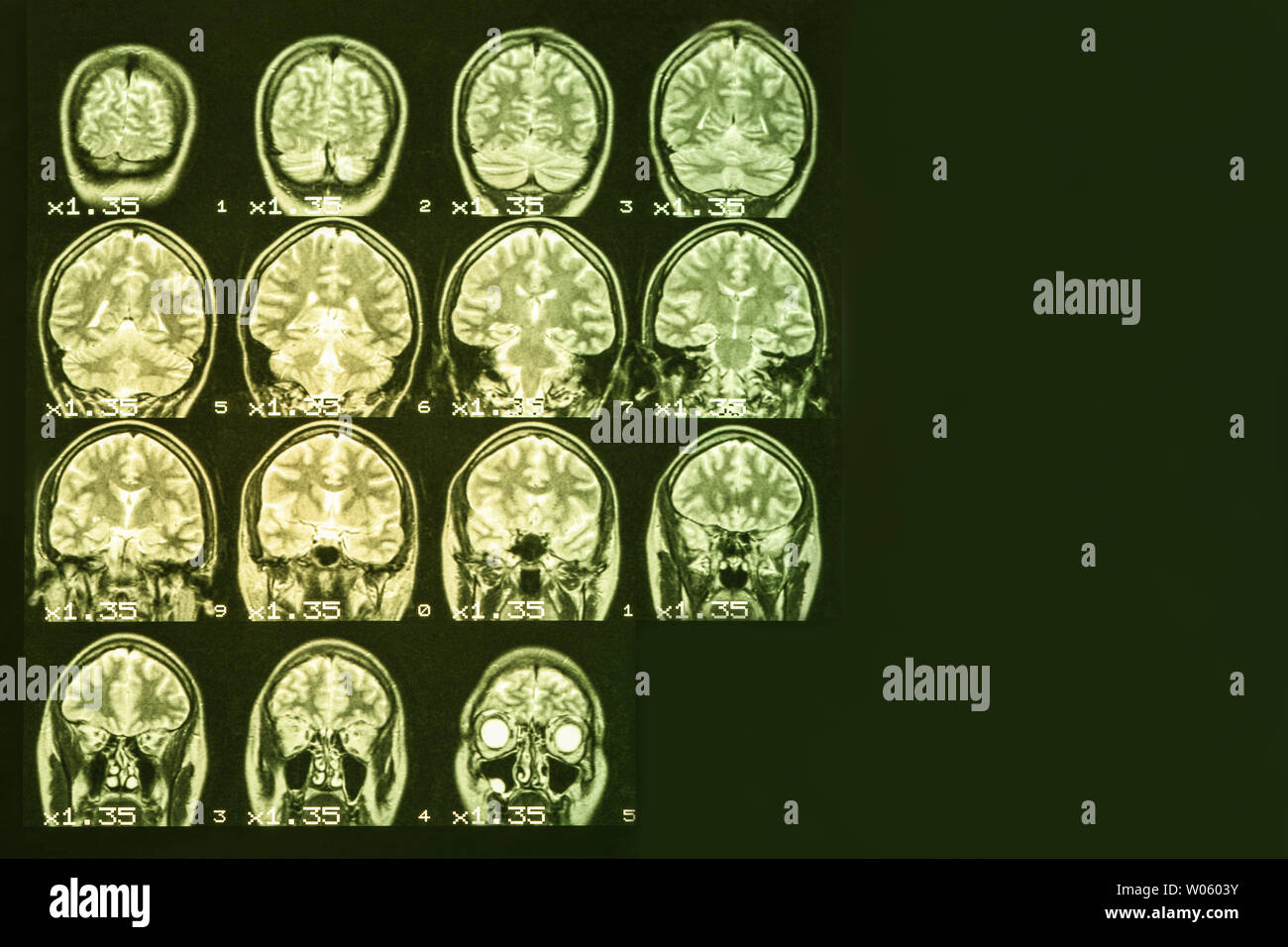 MRI of the brain on a black background with yellow   backlight. Right  place for advertising inscription Stock Photo