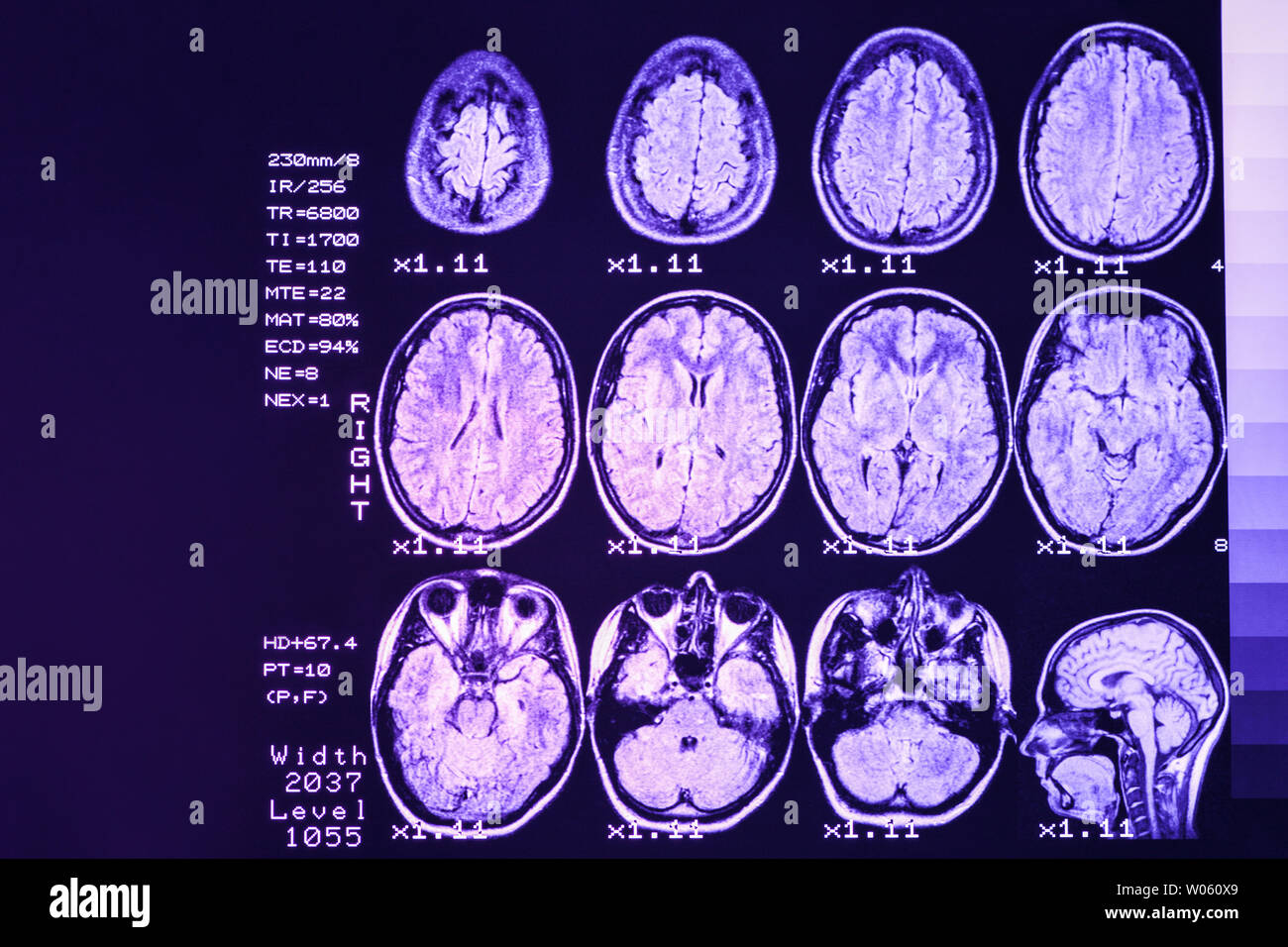 MRI scan or magnetic resonance image of head and brain scan. The result is an MRI of the brain with values and numbers with lilac  backlight. Stock Photo