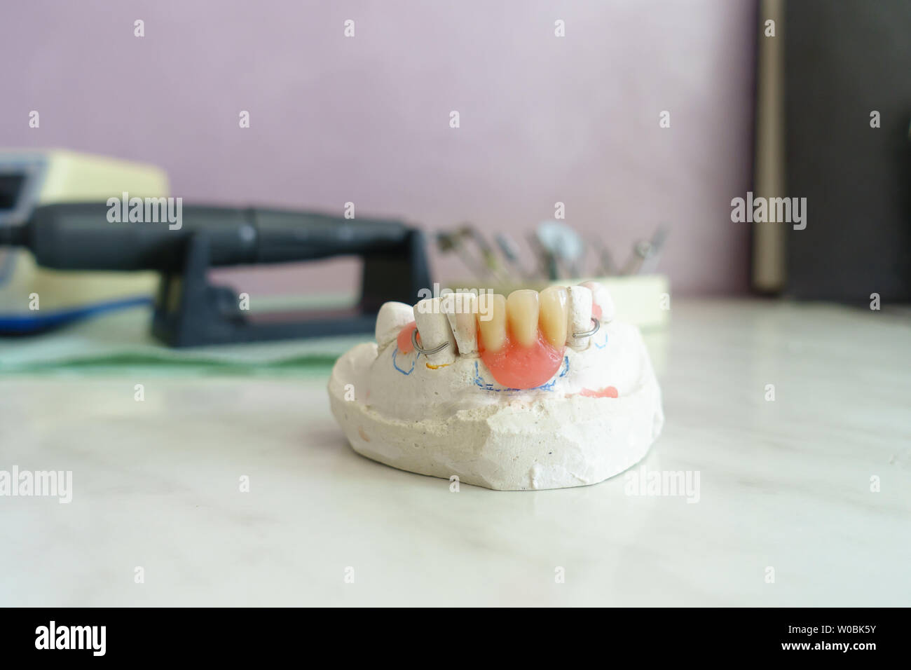 Artificial removable dental prosthesis to restore the integrity of the dentition Stock Photo